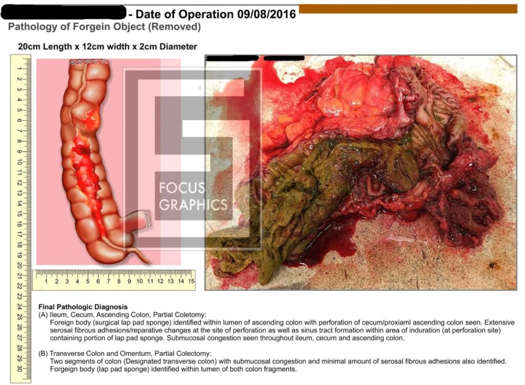 Foreign body removal, along with removed section of colon