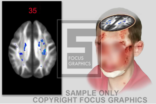 Brain MRI Scan shown on human