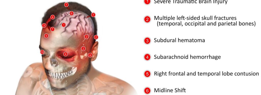 Injuries in the head