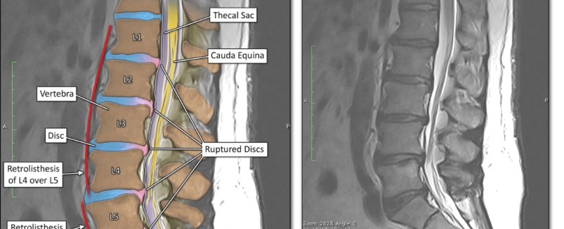 Injuries along the spine
