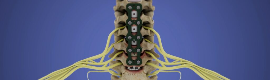Innovative 3D Spine, Focus Graphics