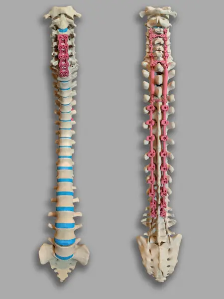 3D printed spine with fusion hardware