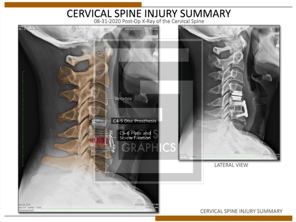 MRI colorization of cervical spine post-op showing hardware