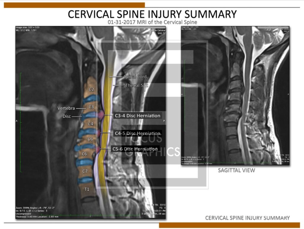 MRI colorization of cervical spine showing disc damage