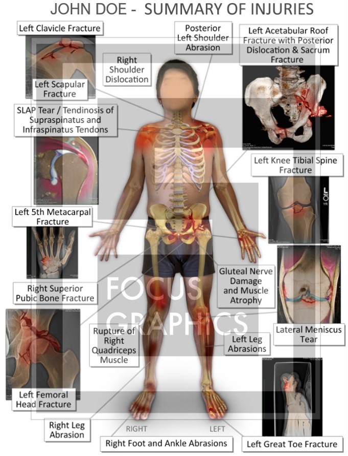 Injury summary board of man hit by car while riding his bike. It outlines all of the injuries sustained.
