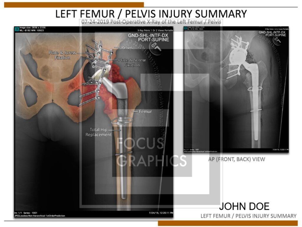 Colorization of xray of left femur and pelvis injury with hardware