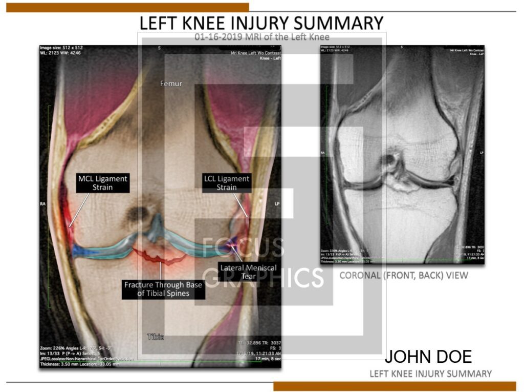 Colorization of left knee MRI to show fracture