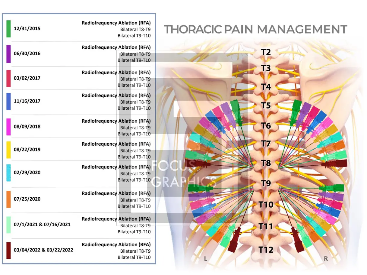 Thoracic pain management summary showing dates and locations of injections