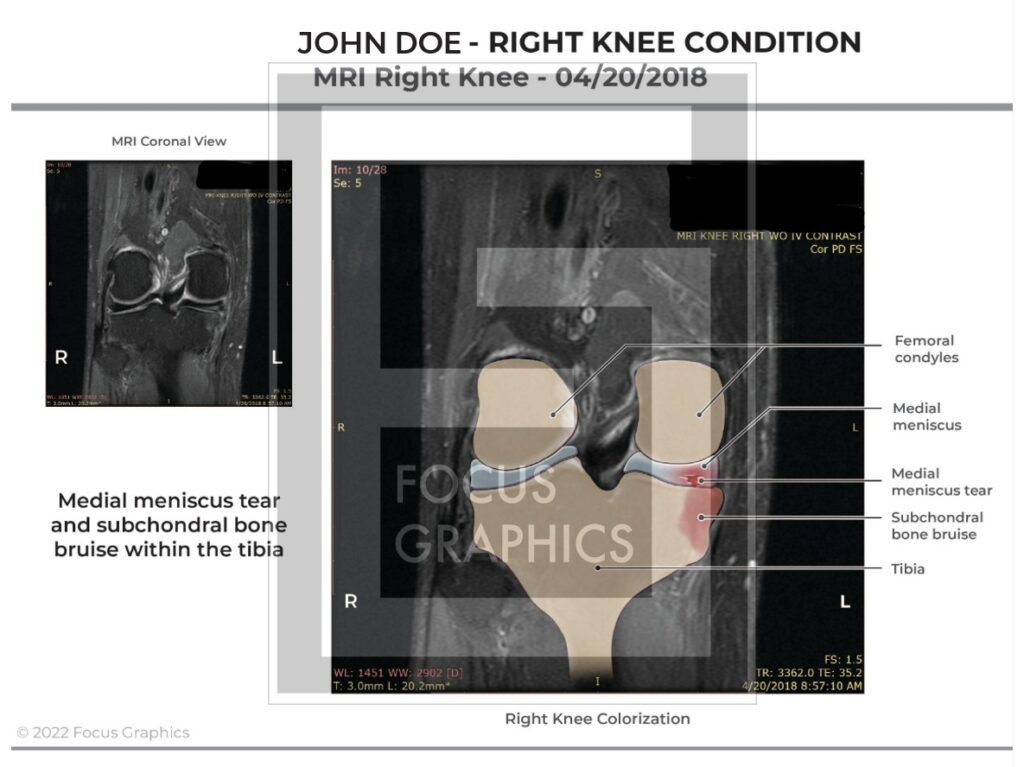MRI of right knee to show damage from motor vehicle collision