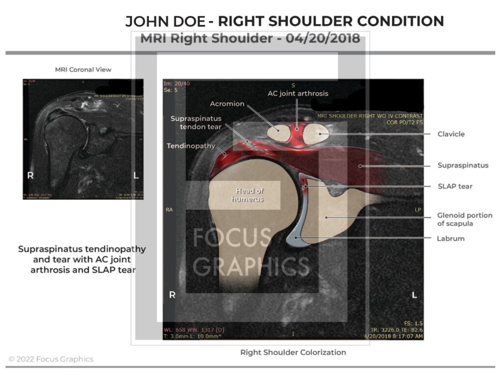 MRI of right shoulder to show damage from motor vehicle collision