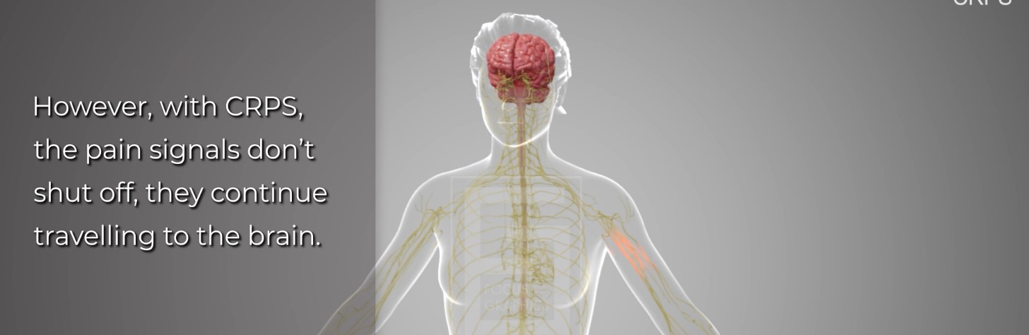 Complex Regional Pain Syndrome (CRPS) - Focus Graphics