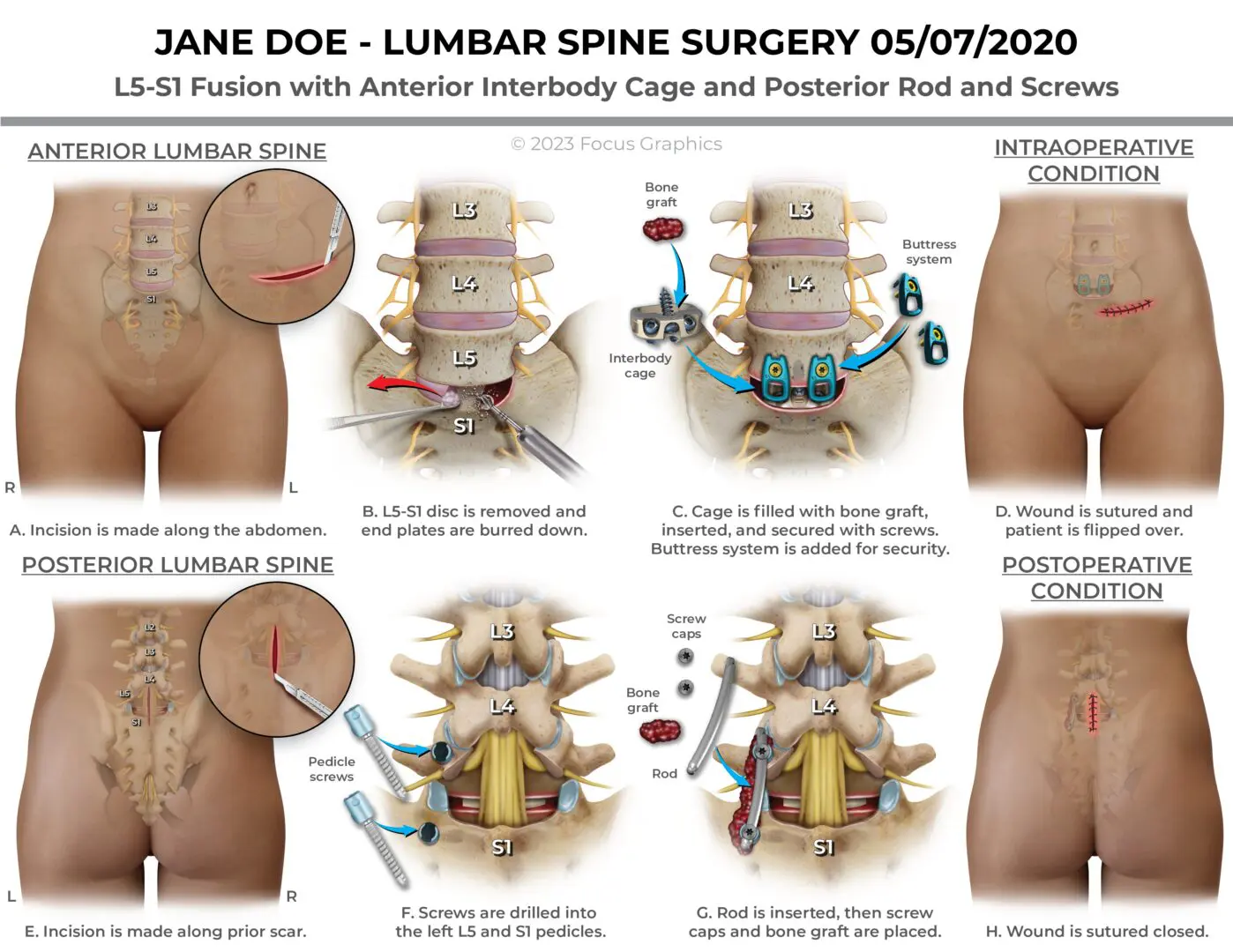 L5-S1-Anterior-Posterior-Fusion-Female-221207