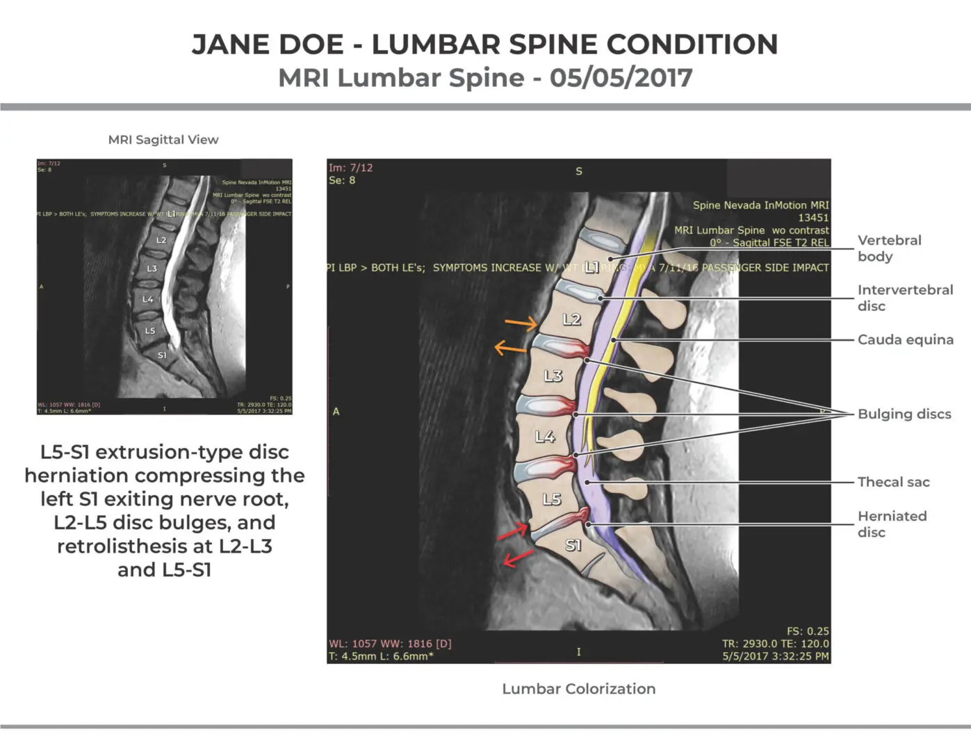 Lumbar-Sagittal-Colorization-1