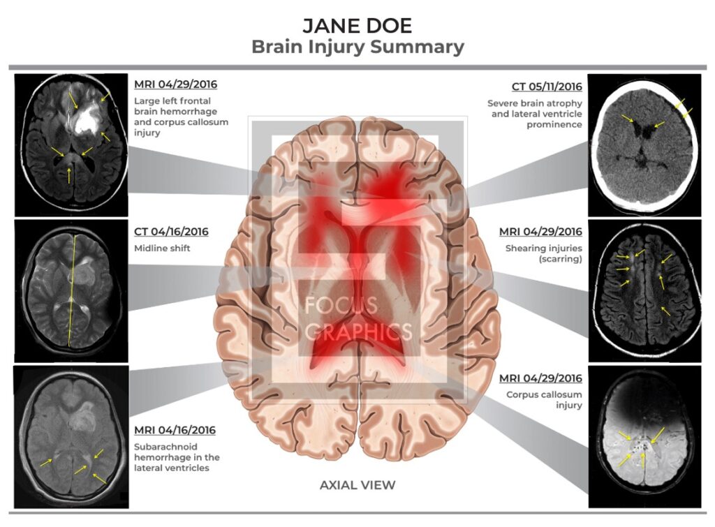 Brain injury summary axial view