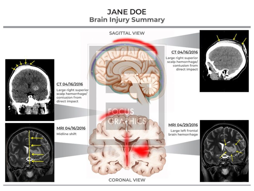 Brain injury summary coronal view