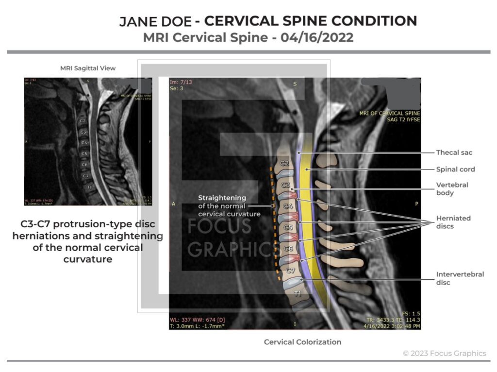 Colorized neck MRI showing herniations