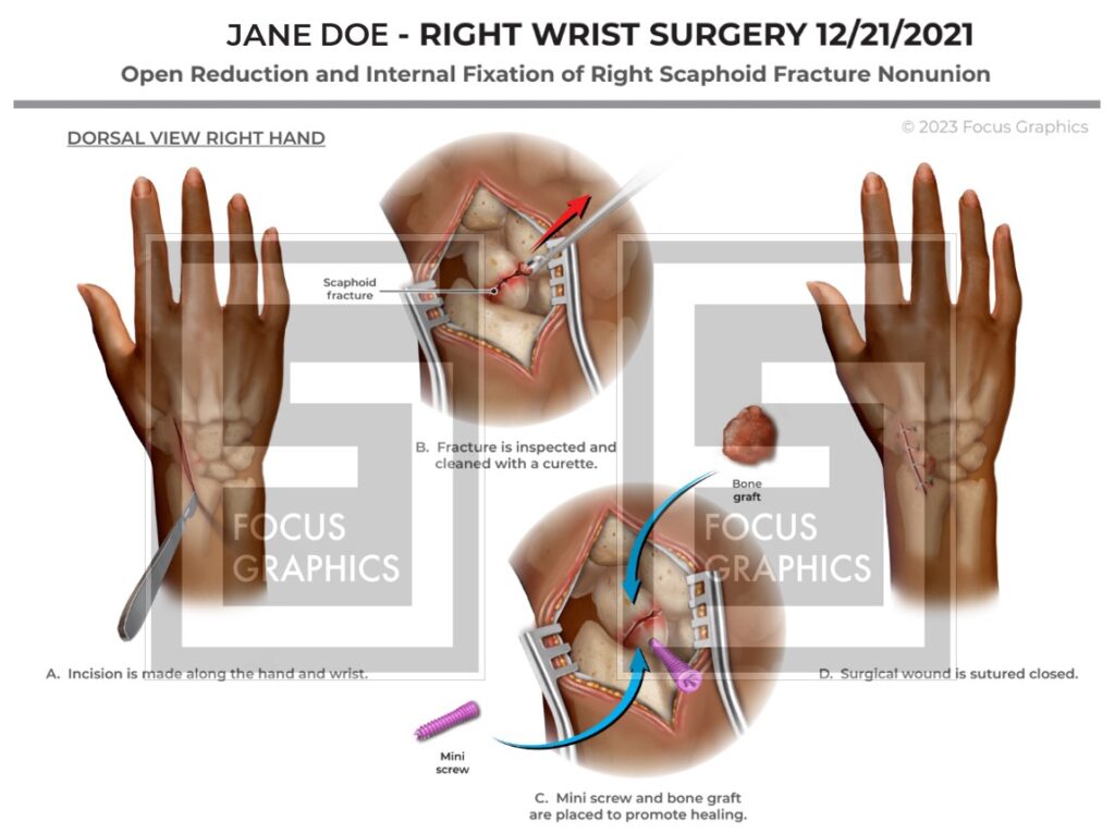 Surgical illustration showing repair of scaphoid bone