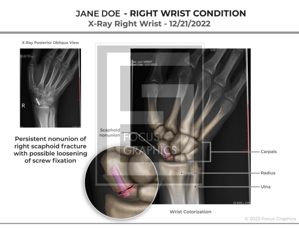 Colorized xray showing failure of scaphoid repair