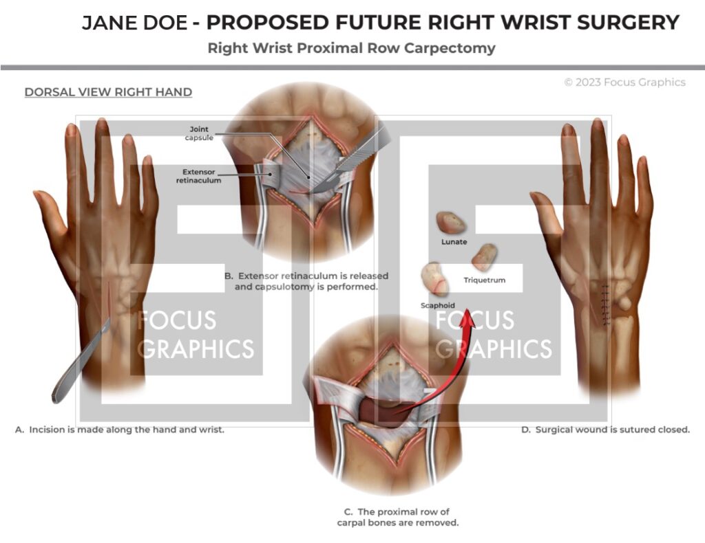 Surgical illustration for future surgery to fix failed scaphoid repair