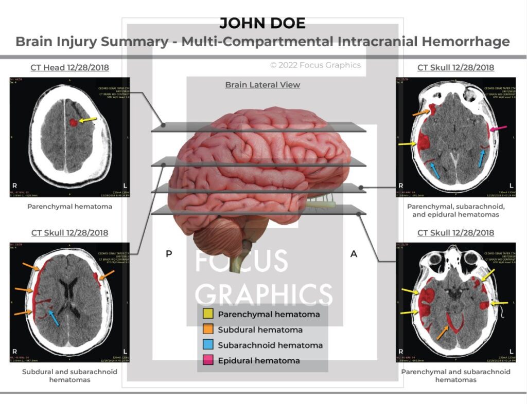 Brain injury summary