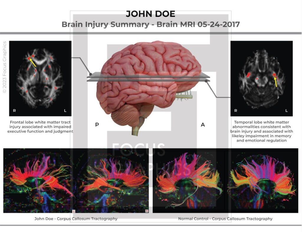 Brain injury summary