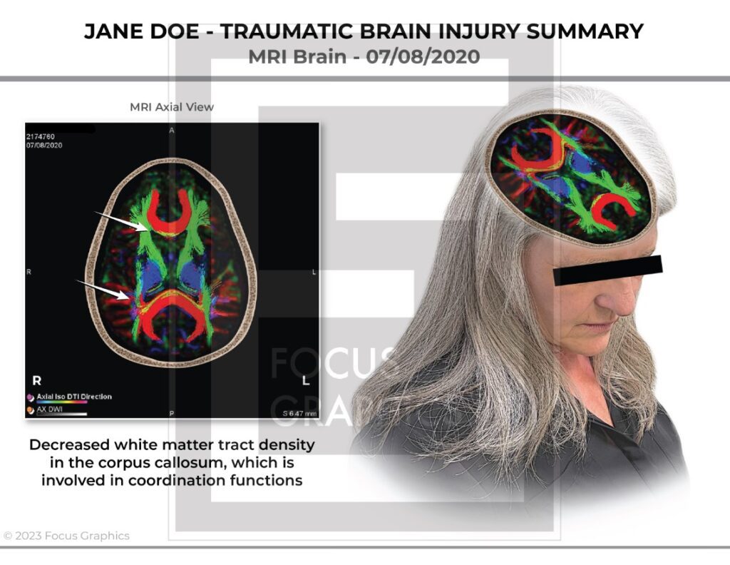 Brain slicer image