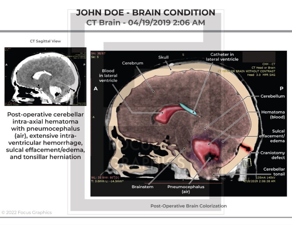 Brain CT scan colorization