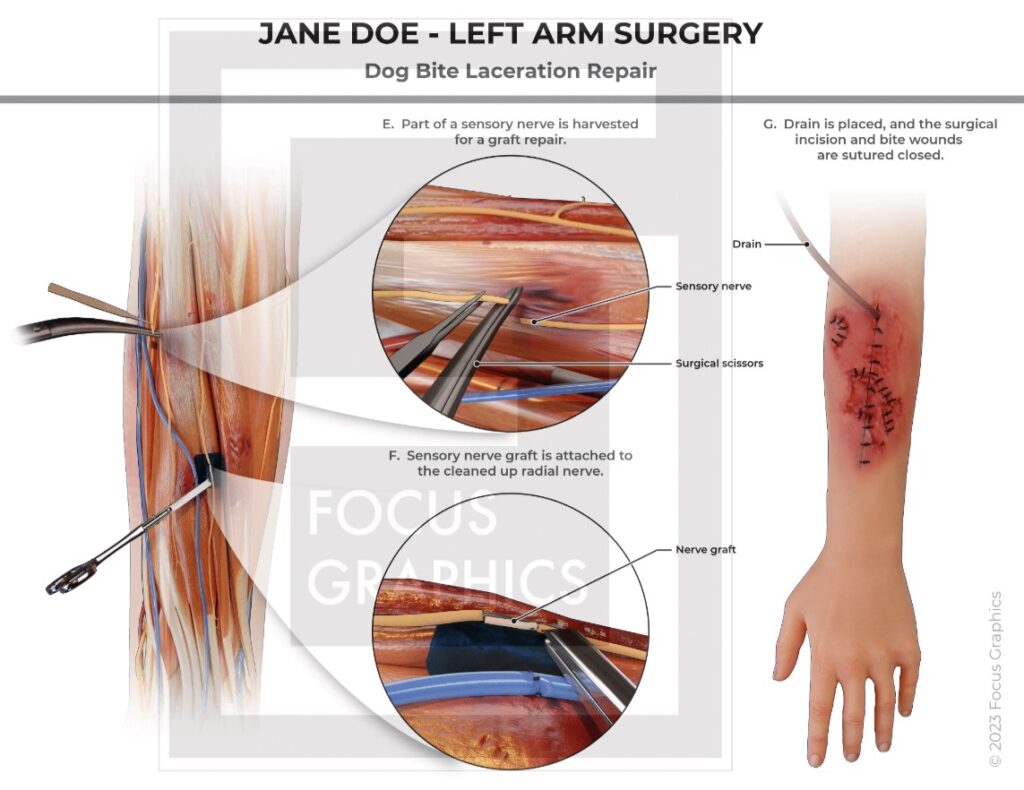 Dog bite clearance surgery