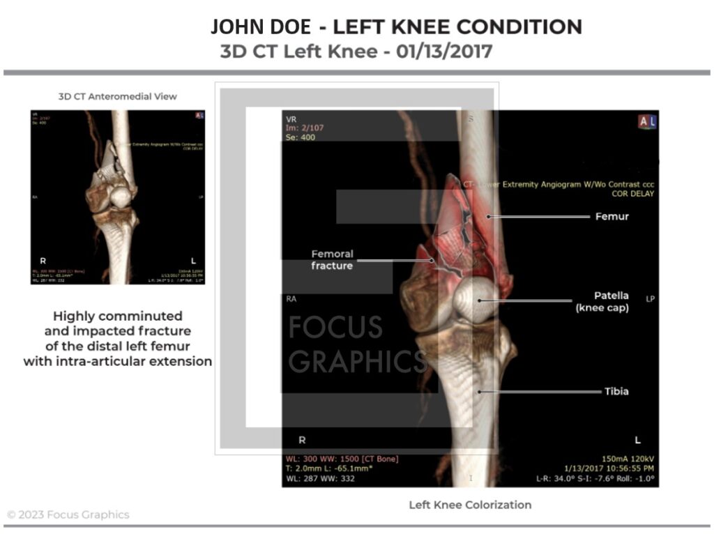 Colorization of CT scan of left knee