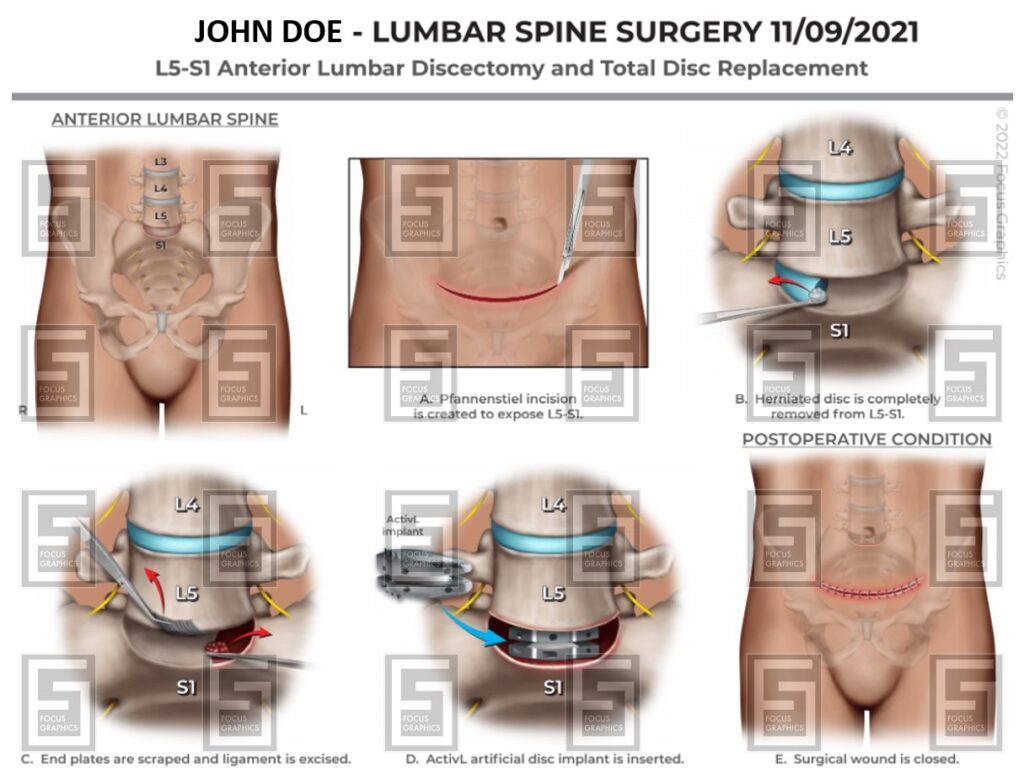 lumbar spine surgical illustration