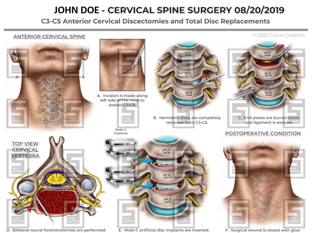 cervical spine surgical illustration