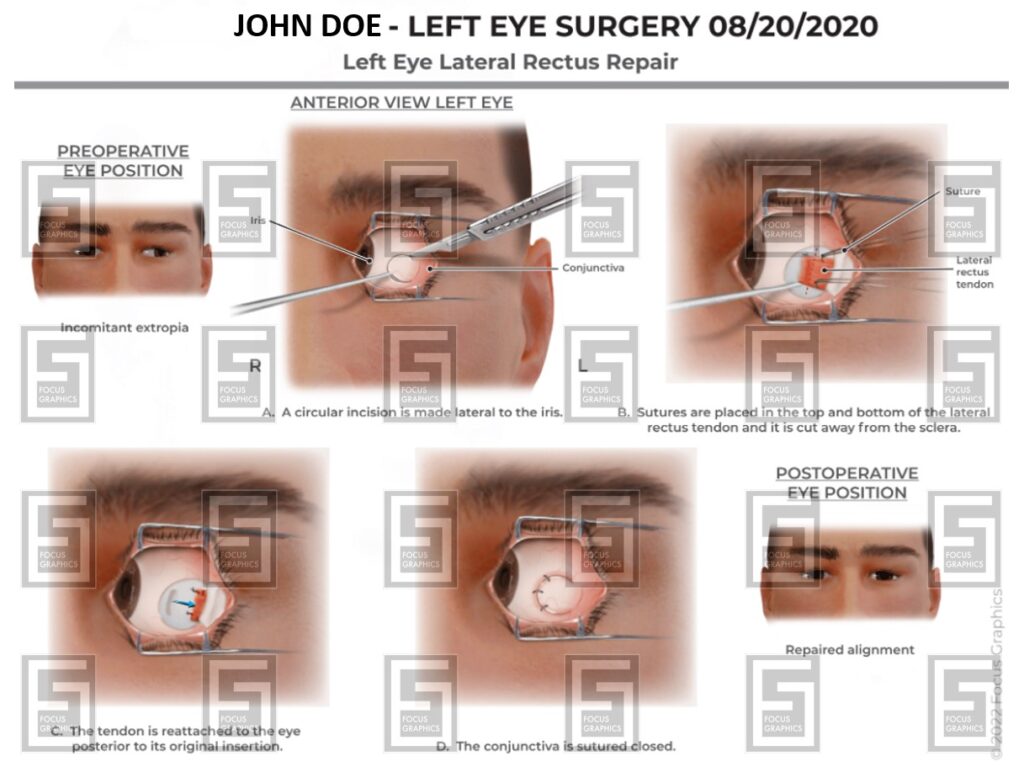 Left eye repair surgical illustration