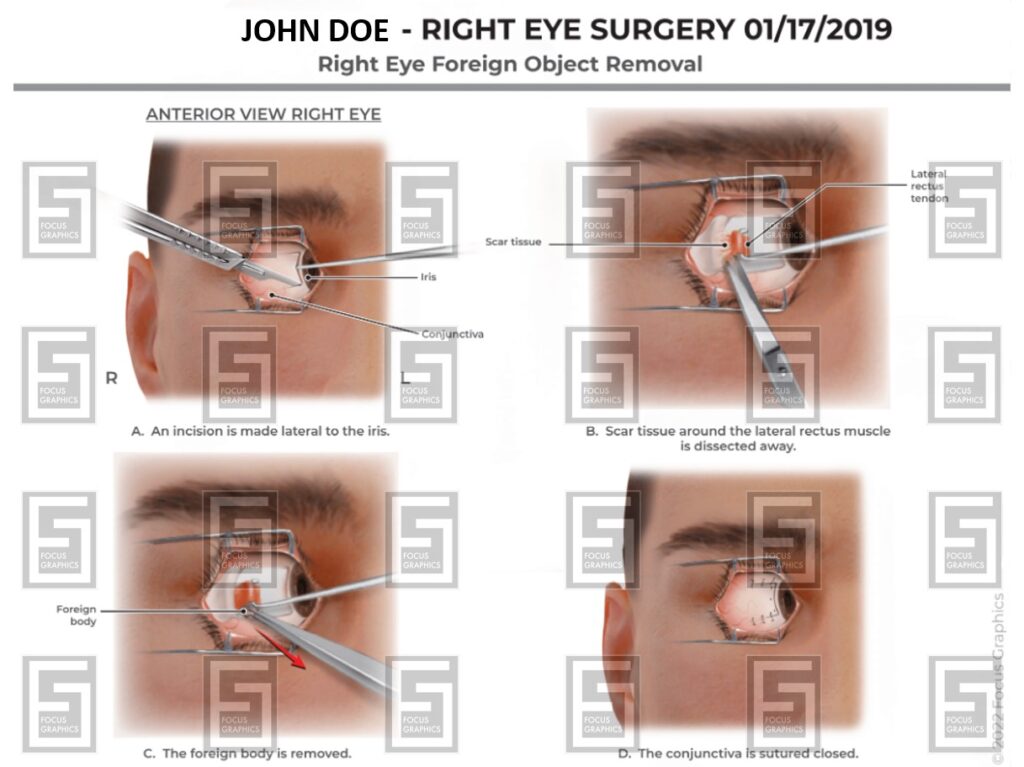 right eye foreign body removal surgical illustration