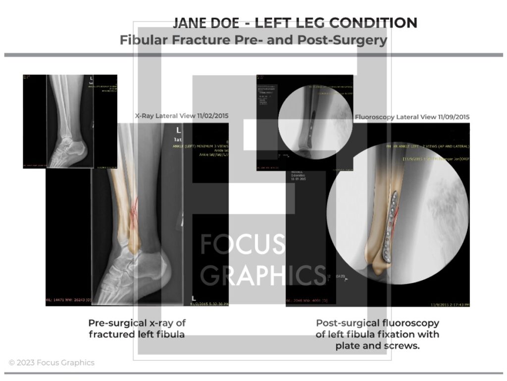Comparison of pre- and post-op imaging of a broken ankle