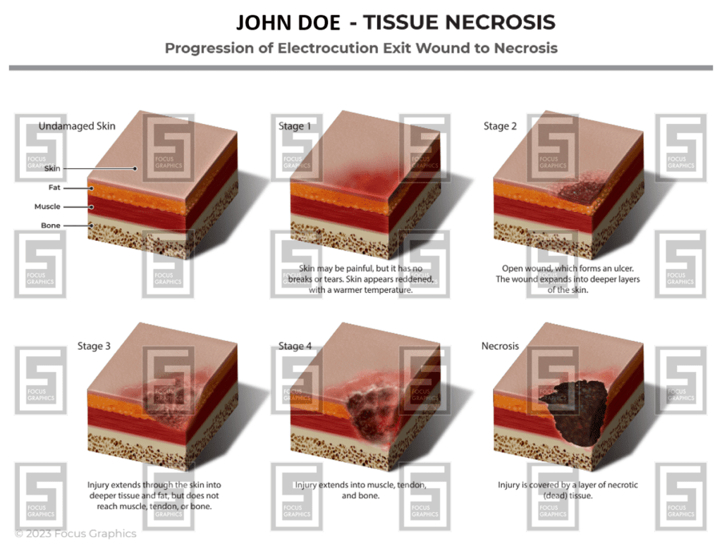 progression of tissue necrosis