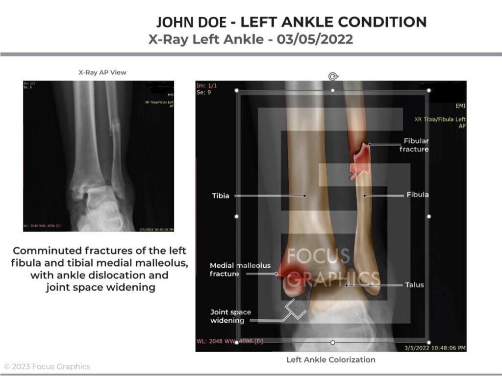 Colorization of broken left ankle