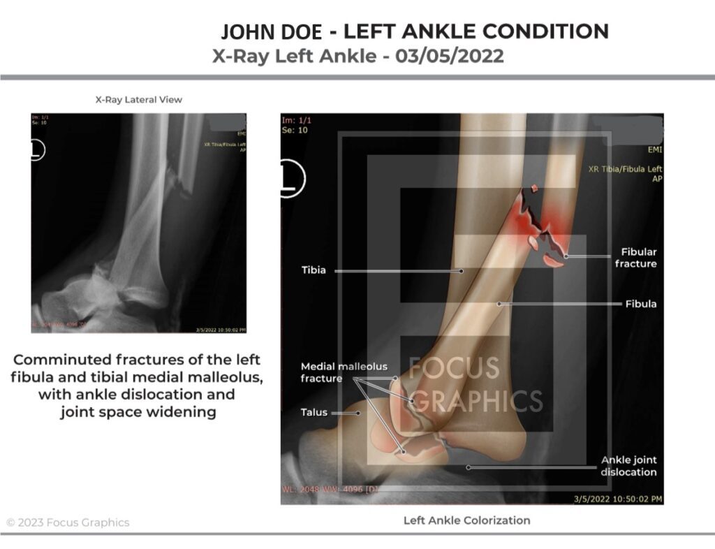 Colorization of broken left ankle