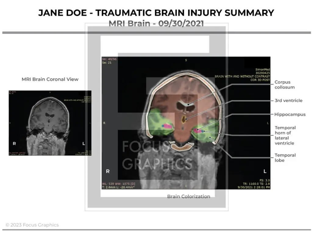 Brain injury summary