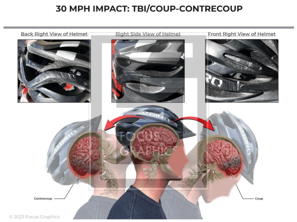 Legal exhibit showing damaged helmet from a bicycle rider who got hit by a vehicle. It also shows how a coup-contrecoup injury occurs.