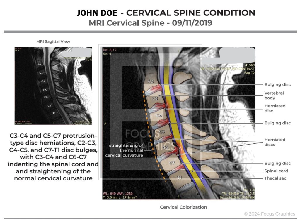 Colorized MRI imaging of cervical spine