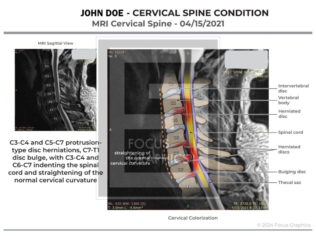 Colorized MRI imaging of cervical spine