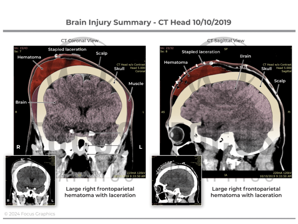 Brain injury summary showing large hematoma