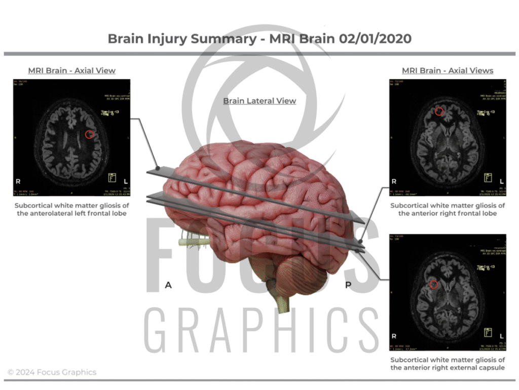 Brain injury summary showing MRI slices