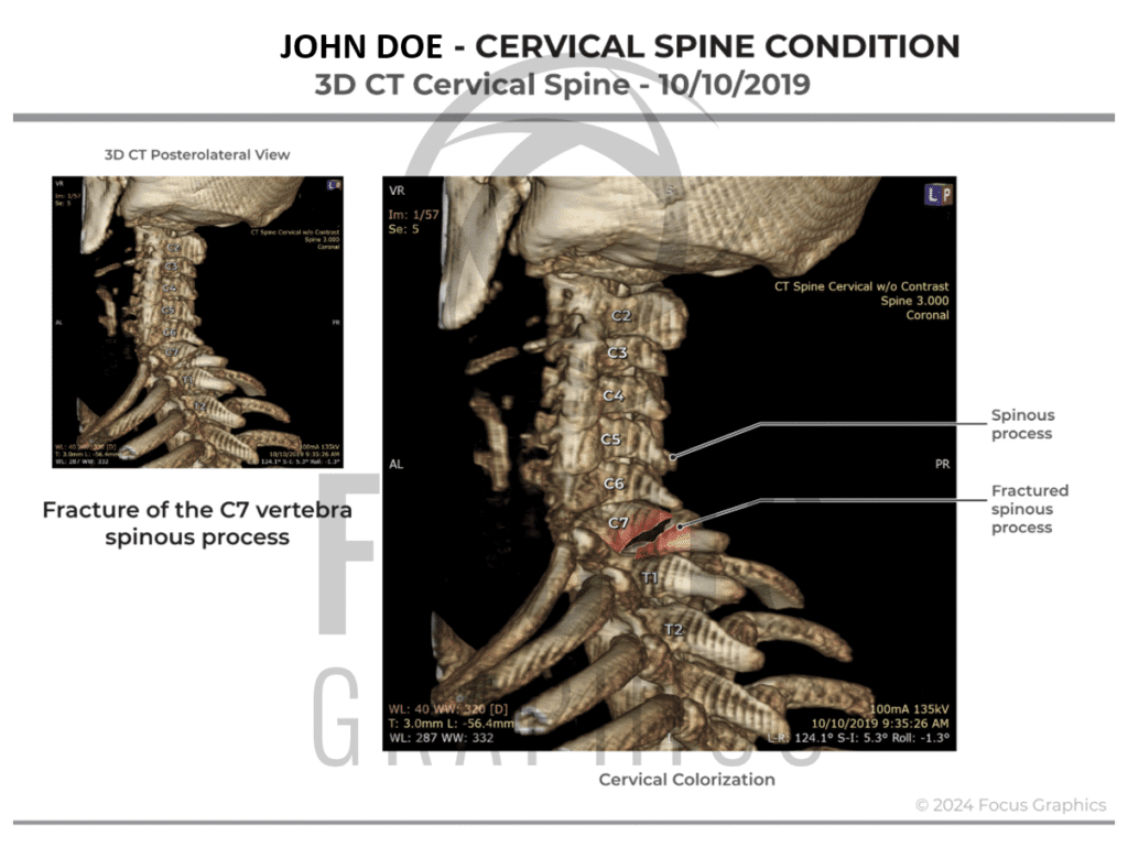 Colorized Cervical spine condition