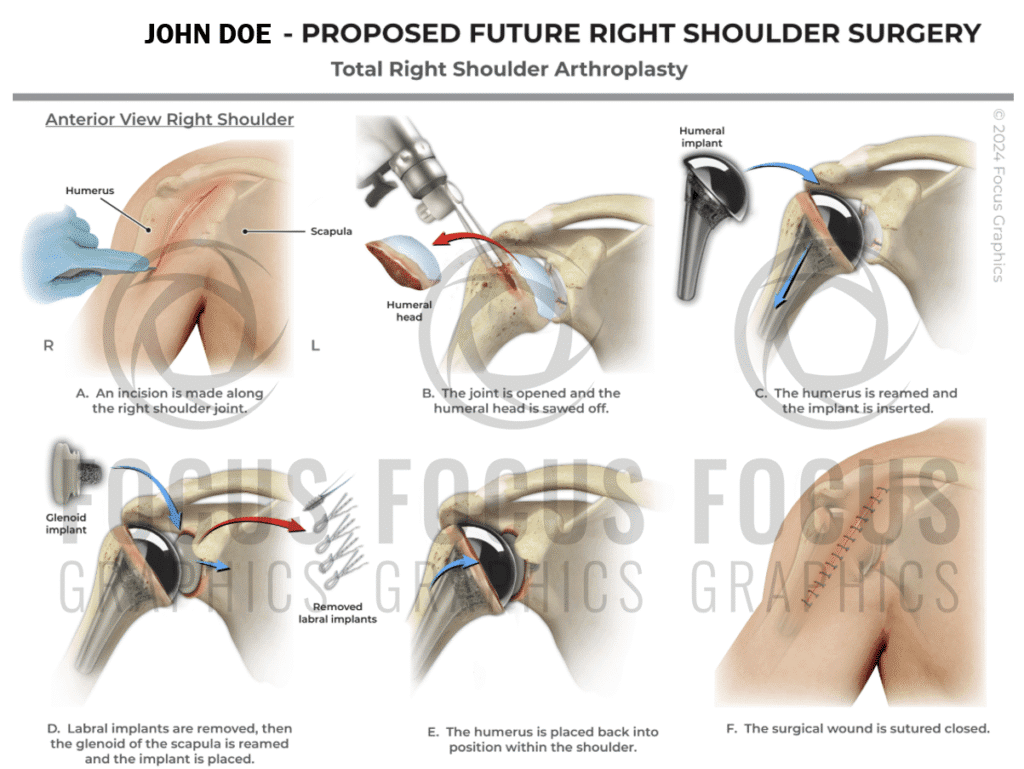 Total right shoulder arthroplasty surgical illustration, recommended future surgery