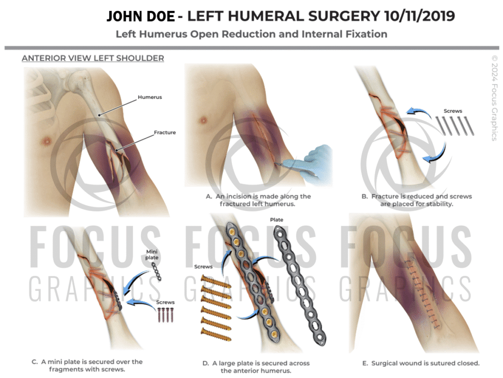 Left Humerus ORIF surgical illustration