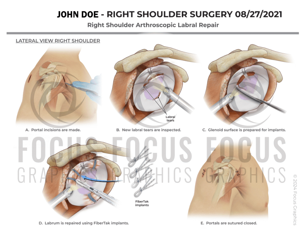 Right shoulder arthroscopic labral repair surgical illustration