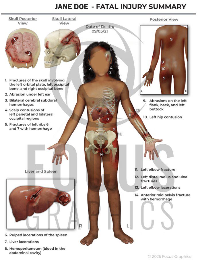Fatal injury summary showing a girl with many injuries sustained after a fall from an amusement ride